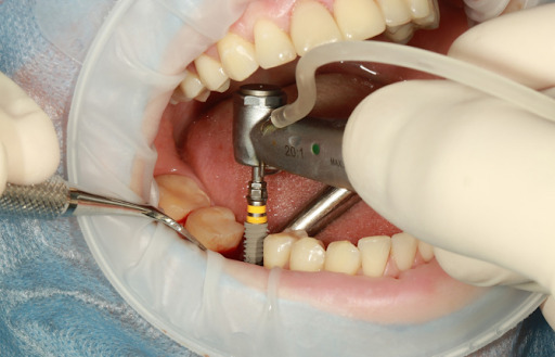 Cấy Implant tức thì sau khi nhổ răng giúp rút ngắn thời gian điều trị
