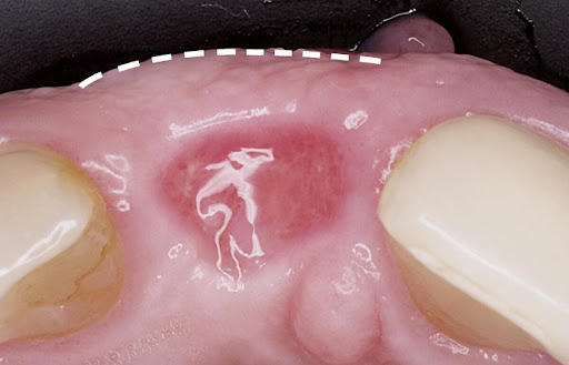 3 tháng sau khi nhổ răng là thời điểm rất thuận lợi để đặt trụ Implant
